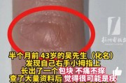 43岁男子手指异样怀疑感染HPV 竟是持机姿势不当所致